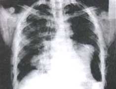 Signo de pulmón caído. Radiografía AP