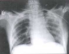 Rx inicial  AP fracturas costales izquierdas y contusión pulmonar.