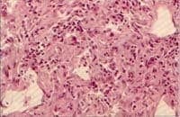 Estudio histológico de masa con neoplasia constituída por células histiocitoides