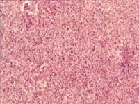 Estudio histológico de masa con neoplasia constituída por células histiocitoides