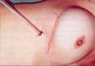 Incisión en el pliegue submamario suturada subcuticularmente
