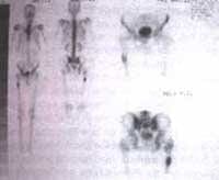 Radiografía de fémur derecho con lesión osteolítica