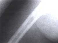 Radiografía de fémur derecho con lesión osteolítica1