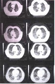 TAC de tórax con lesiones nodulares no calcificadas bilaterales