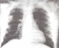 Radiografía de tórax con opacidad en lóbulo superior derecho