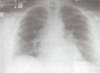 Rx tórax con  infiltrados pulmonares intersticiales