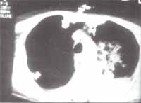 Autopsia caso clínico No 2 trombosis masiva de venas pulmonares