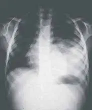 Rx de base pulmonar izquierda y posterobasal