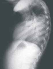 Radiografía de tórax. Proyección lateral