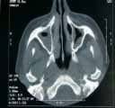 TAC de senos paranasales demostrando sinusitis aguda maxilar bilateral