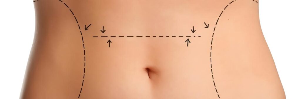 Velashape para contorno corporal
