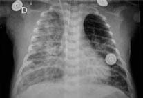 Rx de tórax con compromiso alveolar atelectasias subsegmentarias