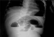 Radiografía de abdomen con niveles hidroaéreos
