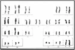 Traslocación Robertsoniana entre el cromosoma