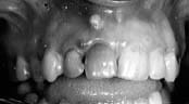 Absceso periodontal como causa de adenopatías.