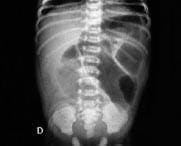 Radiografía de abdomen