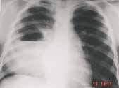 Existe imagen densa redondeada en la base pulmonar derecha
