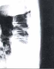 Radiografía de Columna Torácica proyección lateral