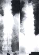 Radiografía Simple de Columna Tóracica baja y lumbar. Proyección AP