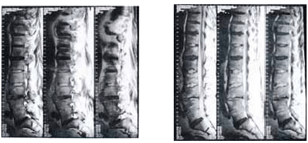 Resonancia Magnética sagital de columna lumbo sacra T1