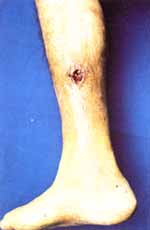 Ulcera de 2x3 centímetros localizada en el aspecto lateral de la pierna derecha que muestra exudación de cristales de urato monosódico a través de ella.