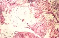 Piel. Depósitos de material eosinófilo amorfo en la dermis profunda