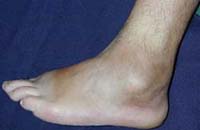 Se aprecia cicatriz en la región posterior del maléolo externo del pie izquierdo, luego de resección, donde se encontró el tofo