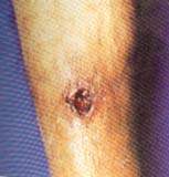  Lesión ulcerada en cara externa de pierna derecha secundaria a paniculitis por gota