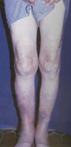 Se aprecian múltiples tofos calcificados a nivel de rodillas y cara anterior de piernas