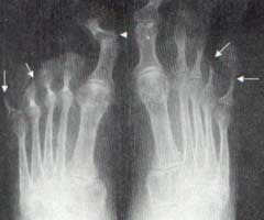 Se aprecian lesiones osteolíticas en las falanges distales del cuarto y quinto dedos de manera bilateral