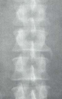 Osteofito margina