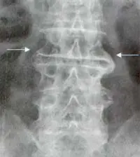 Radiografía frontal de columna lumbar Osteofitos