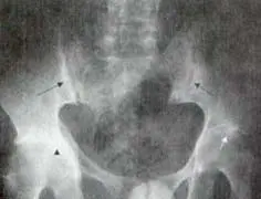 Radiografía de Pelvis. Sacroilitis bilateral. Seudo - ensanchamiento de las articulaciones sacroilíacas