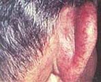 Condritis severa del pabellón auricular en un paciente con GW.