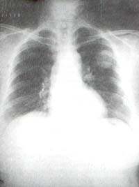 Nódulo pulmonar en la región superior de hemitórax izquierdo