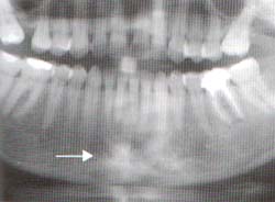  Radiografía de maxilar inferior. Se observan lesiones escleróticas en la rama izquierda, interpretadas como secuelas de osteomielitis. (Flecha)