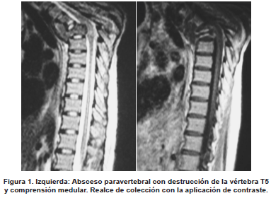 Absceso paravertebral con destrucción de la vértebra T5 y comprensión medular