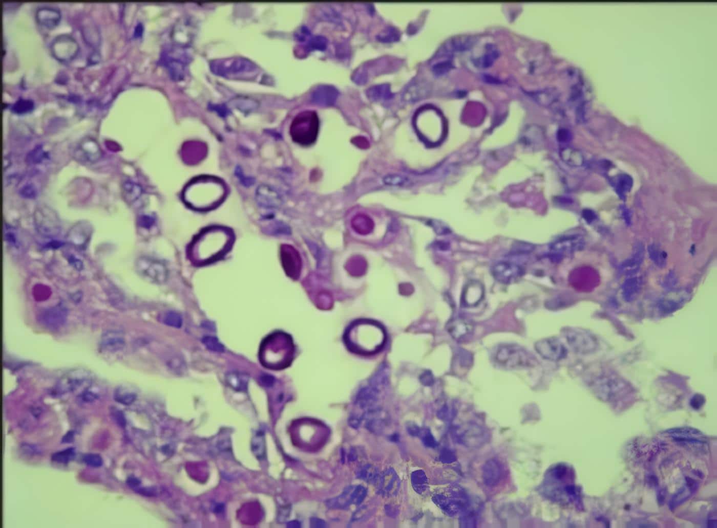 Criptococosis pulmonar