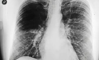 Criptococosis pulmonar