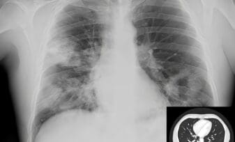 Criptococosis pulmonar.