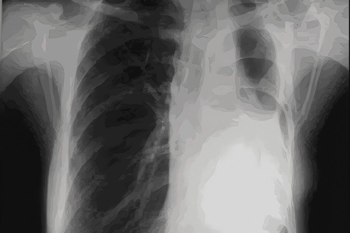 Pleuropulmonar