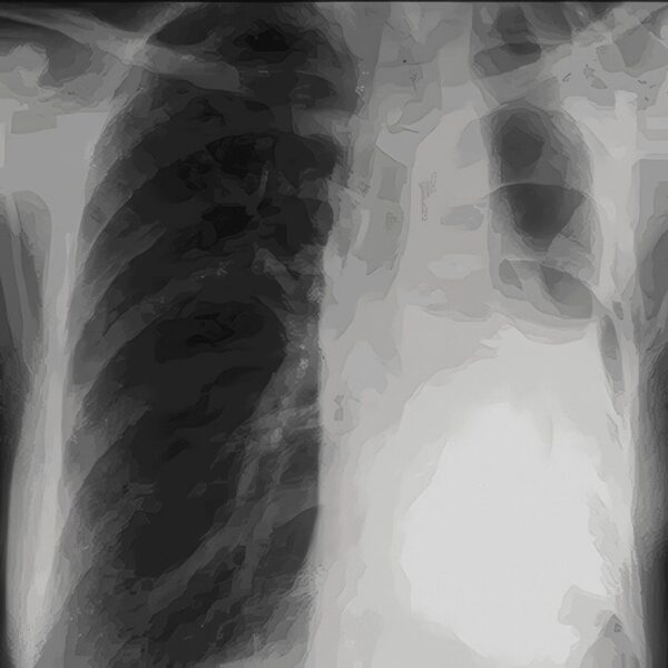 Pleuropulmonar