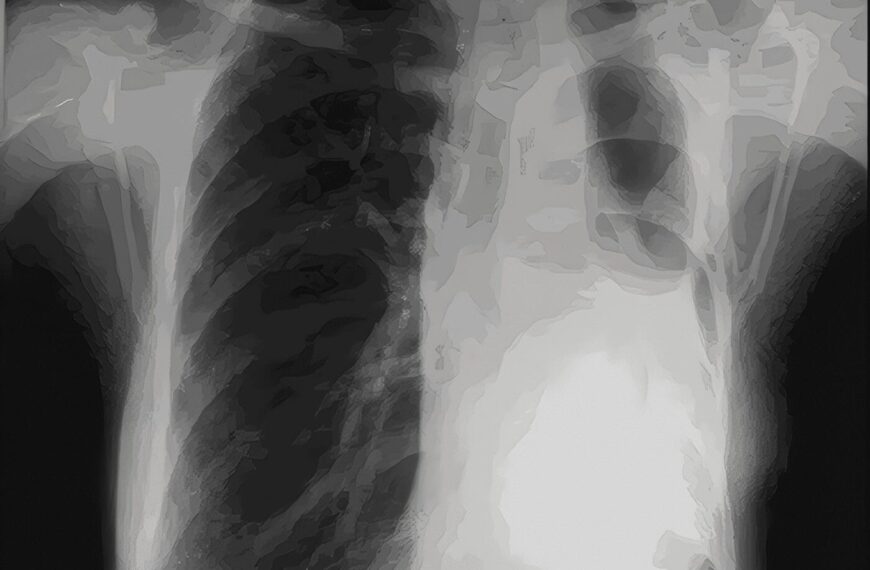 Pleuropulmonar