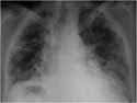 Radiografía PA,  Opacidades intersticiales de patrón