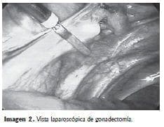 Laparoscòpica de gonadectomìa