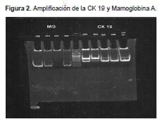 Amplificaciones ck 19 y mamoglobina a