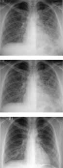 Se observa en la primera radiografía extensas áreas de ocupación alveolar