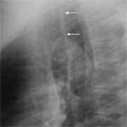 Radiografía lateral de tórax banda traqueal