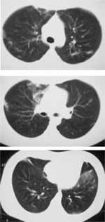 Tomografía con infiltrados de ocupación alveolar