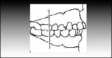 Clase 1 molar de Angle